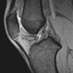 膝関節検査